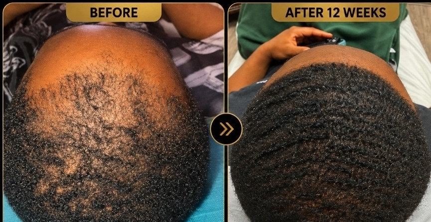 Authentic client photographs of a man's crown before and after twelve weeks